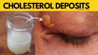 Fastest Way To Get Rid Of Xanthelasma  Squeeze Out Cholesterol Deposits Around Your Eyes [upl. by Bora]