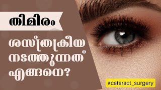 തിമിര ശസ്ത്രക്രീയ നടത്തുന്നത് എങ്ങനെ All About Cataract Surgery  Doctor Live Explainer [upl. by Buhler]