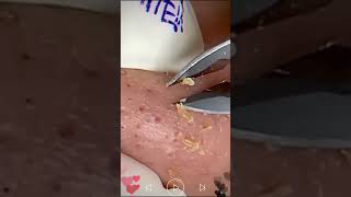 Skincare  Blackheads Removal 089 skincare skincare blackheads blackheads [upl. by Lunt359]