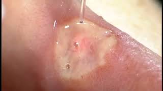 Herpetic Lesion treated with Biolase Epic Laser [upl. by Melamed6]