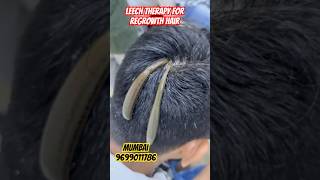 Which therapy is best for hair regrowth  LEECH THERAPY hairhaircareshortsreelstrendingviral [upl. by Dygert]