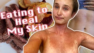 Skin Update  What I Eat for Healthy Skin  5 MONTHS TOPICAL STEROID WITHDRAWAL [upl. by Sharman]