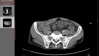 CT Angiography Case13 Intestinal malrotation  Midgut Volvulus [upl. by Domenech]