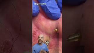 This is an iconic ear cyst extraction 👂credit aguanab0ca on TT doctor satisfying viral [upl. by Sualk]