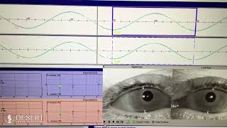 Normal Eye Movements pursuit test  Desert Brain and Spine [upl. by Falda843]