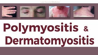 A Simplified Overview of Polymyositis amp Dermatomyositis  Clinical Features Diagnosis amp Treatment [upl. by Guadalupe]