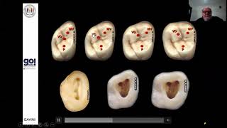 ANATOMIA INTERNA e CIRURGIA DE ACESSO ENDODÔNTICO EM MOLARES parte 2 [upl. by Khanna]