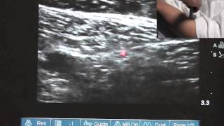 Ultrasound Guided Saphenous Nerve Block  SSRAUSAcom [upl. by Nurav]