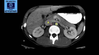 ct abdomen normal anatomy identifying ivc aorta [upl. by Orlene]