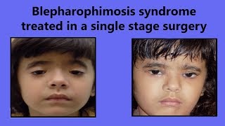 Blepharophimosis Syndrome  Epicanthic Folds Treated By Hanging Man Double Z Plasty Surgery [upl. by Adda]