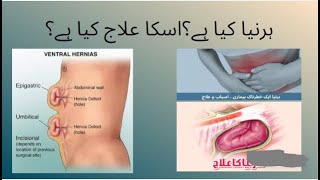 hernia  hernia symptoms in men amp women  hernia surgery amp recovery  ہرنیا کا علاج کیا ہے؟ فتاق [upl. by Yriek]