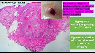 Keratoacanthoma EVERYTHING you need to know  Etiologyclinical featuresHistopathTreatment [upl. by Jaela]