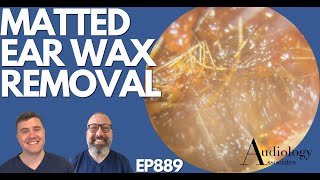 MATTED EAR WAX REMOVAL  EP889 [upl. by Orimlede903]