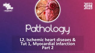 L2Tut1 Part 2  Ischemic heart diseaes  Myocardial infarction Pathology [upl. by Hacim]