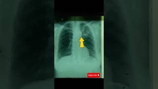 cavitary lesion due to pulmonary TBstudywithme shorts shortsvideo shortsfeed tb pulmonarytb [upl. by Novanod94]