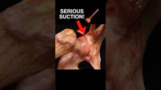 Look how STRONG the suction is of the hip labrum jointpain medschool [upl. by Iosep422]