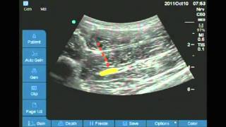 Ultrasound guided anterior sciatic nerve block [upl. by Pelage]