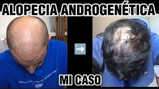 SITUACIÓN ACTUAL ALOPECIA ANDROGENÉTICA [upl. by Chiles]