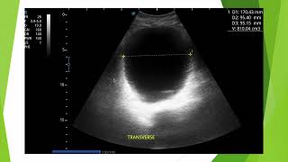 Globe vésical en échographie et piège du miroir [upl. by Ybbob]