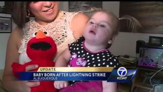 Baby struck by lightning recovering has static hair [upl. by Dayir]