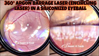 360° Argon Barrage Laser Encircling Laser In a Siliconized Eyeball [upl. by Weiner]