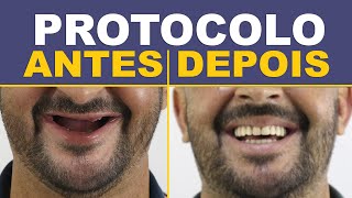 8 Casos de Implantes Protocolo  Antes e Depois [upl. by Adnohsal504]