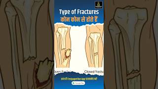 Common types of Bone fracture  Types of Fracture  facture bones shortvideo testpaperlive [upl. by Namzed]