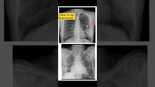 Xray ChestPneumonia 🩻signampsymptomscomplicationsradiologyytshorts [upl. by Nahtaj244]