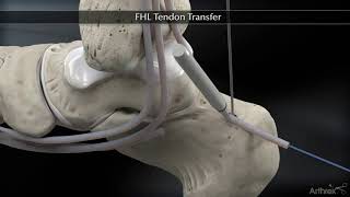 Flexor Hallucis Longus FHL Tendon Transfer [upl. by Veronike]