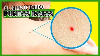 ¿Tienes estos puntos rojos en varias partes de su cuerpo [upl. by Anitnelav]