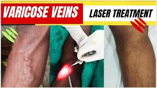 Laser treatment of varicose veins SSC GD medical  Varicose veins treatment Varicose vein laser [upl. by Lleuqram189]