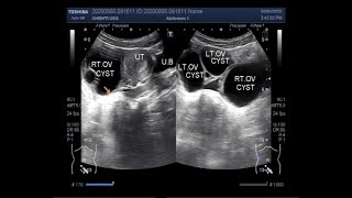 Ultrasound Video showing multiple Ovarian Cysts [upl. by Moira973]