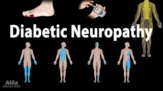 Diabetic Neuropathy Animation [upl. by Rivers]