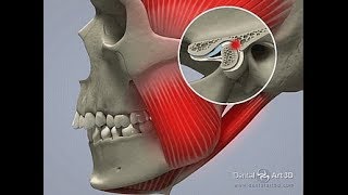 TMD  Temporo Mandibular Disorders [upl. by Adnoval]