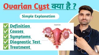 Ovarian Cyst in Hindi  Causes Symptoms And Treatment of Ovarian Cyst [upl. by Veronique366]