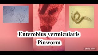 Enterobius vermicularis  Pinworm  Parasitology  pathCast [upl. by Mead]