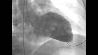 Ventricular Fibrillation during Left Ventriculography [upl. by Nojad]