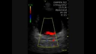 Vscan Lithiases rénales bilatérales Echographie Urologie Urgences [upl. by Rolecnahc480]