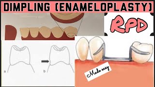 DIMPLING ENAMELOPLASTY II PROSTHETIC MOUTH PREPARATION II REMOVABLE PARTIAL DENTURE I PROSTHODONTICS [upl. by Guria]