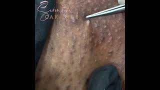 Blackheads Ingrown hair  and Cop Stories [upl. by Ause]