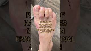 Revision of Hammertoe with Minimally Invasive Approach  NO PINS NO SCREWS [upl. by Ermine]