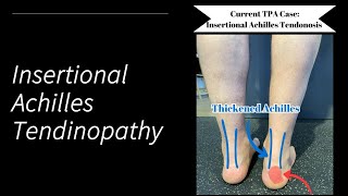 Insertional Achilles Tendinopathy [upl. by Ezequiel]