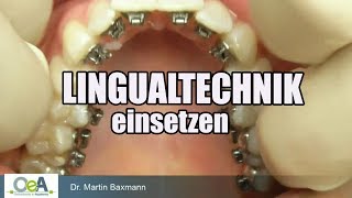 LINGUALTECHNIK einsetzen  placing FIXED LINGUAL BRACES I OeA [upl. by Otreblada]