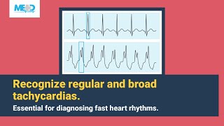 How to identify regular and broad tachycardias [upl. by Cilka]