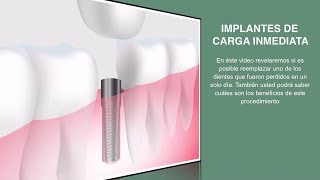 Implantes Dentales en 1 solo día  Implantes de carga inmediata en Bogotá DR Iván Lindo [upl. by Gefen]