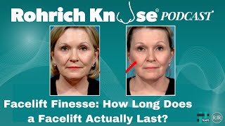 Facelift Longevity How Long Does a Facelift Actually Last [upl. by Hulburt800]