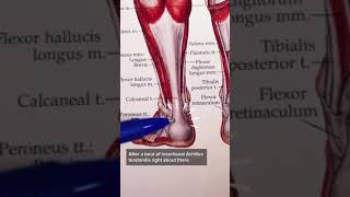 Insertional Achilles Tendonitis [upl. by Nyluqcaj]