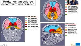 Tomografía de cráneo y EVC [upl. by Assirehs]