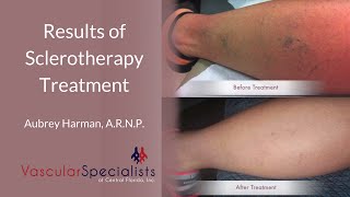 What Are the Results of Sclerotherapy Treatment [upl. by Yanaton]