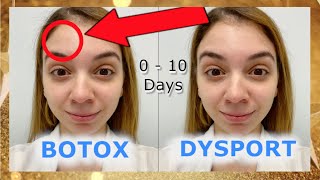 Botox Vs Dysport  Before and After [upl. by Ahsinauj]